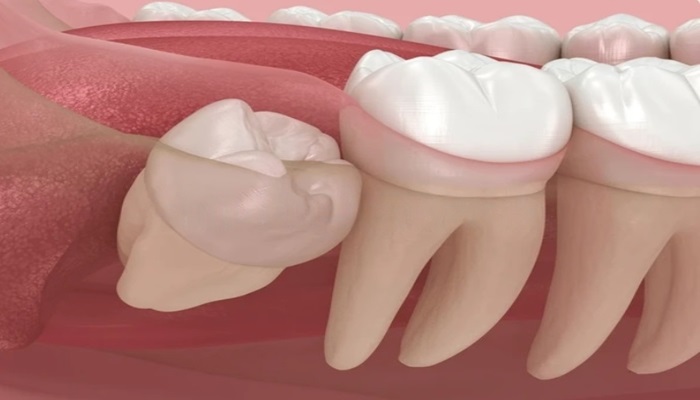 Wisdom teeth