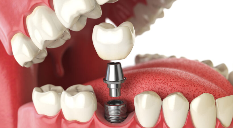 dental implants Christchurch