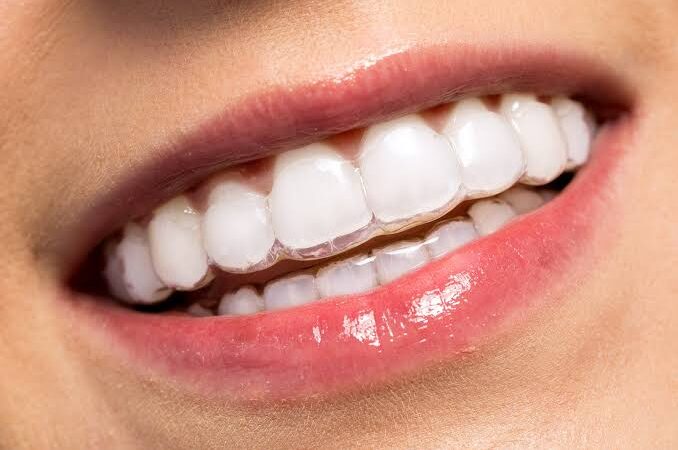 Invisalign Enmore